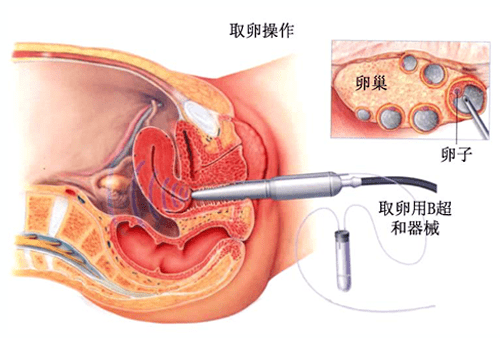 供卵试管婴儿降调通常需要多长时间